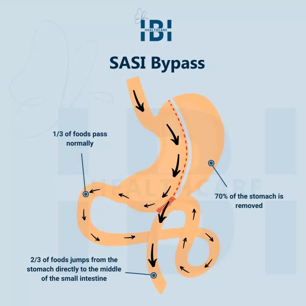 Bypass Único de Anastomosis de Manga Ileal (SASI)