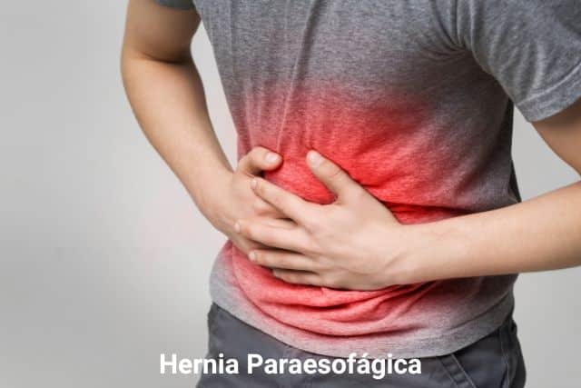 hernia paraesofagica