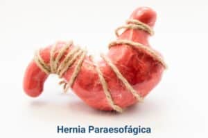 hernia paraesofagica