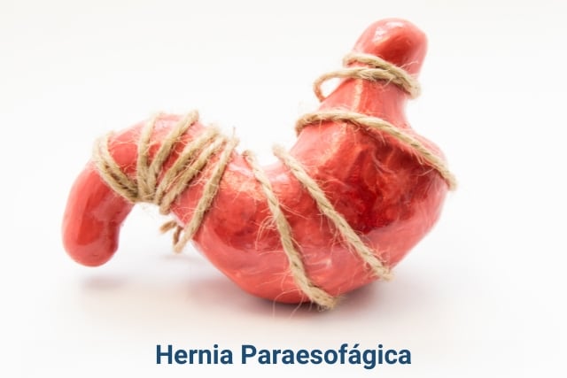 hernia paraesofagica