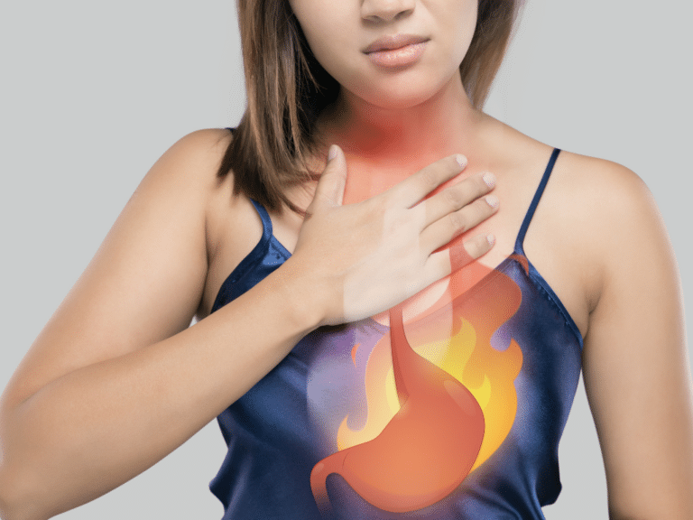 Acid Reflux GERD Symptoms