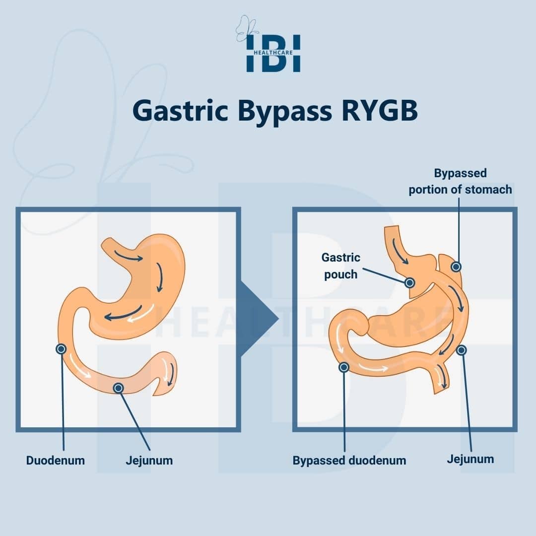 Gastric Sleeve Recovery: Tips for Quick Recovery Post Surgery