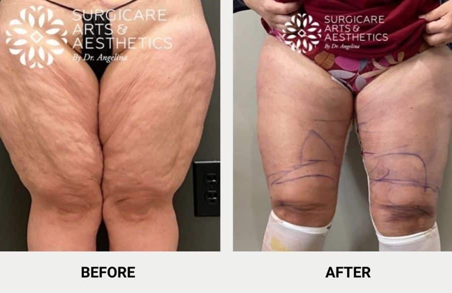 A Body Lift Can Remove Sagging Skin From Extreme Weight Loss