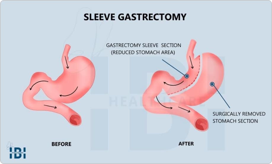 Gastric Sleeve, Sleeve Gastrectomy, VSG (Vertical Sleeve Gastrectomy)  Surgery - Bariatric Surgery