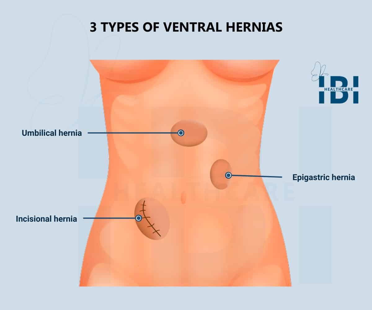 Ventral Hernia: What It Is, Symptoms, Types, Treatment & Repair