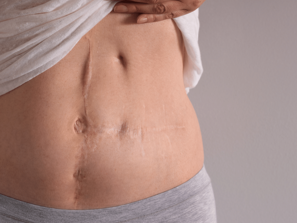 Gastric Sleeve Scars and Incisions: Scarless Alternatives Available