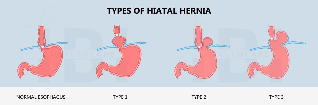 What Size Hiatal Hernia Needs Surgery