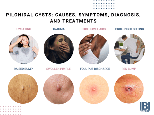 Why Is a Pilonidal Cyst Not Really a Cyst? - Sternberg Clinic