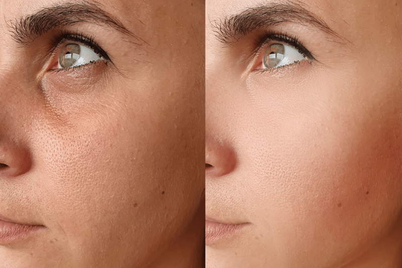 Dermal and Face Fillers FAQs