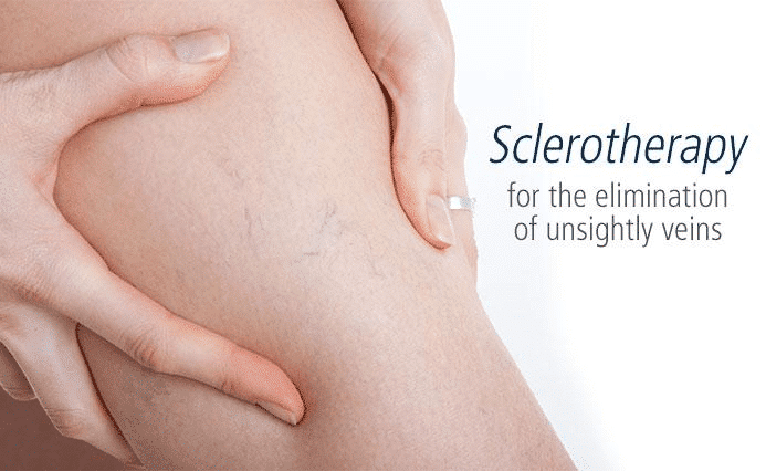 Sclerotherapy and Phlebectomy | Effective Spider Veins Treatment