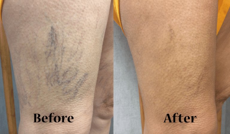 Sclerotherapy and Phlebectomy | Effective Spider Veins Treatment