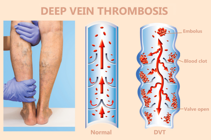 Peripheral Venous Disease PVD vs. Peripheral Artery Disease PAD