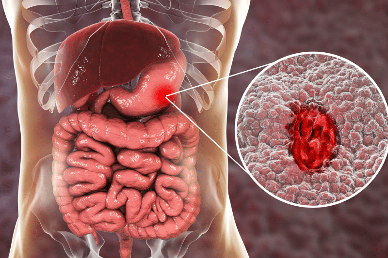 Gastrointestinal Tract Diseases