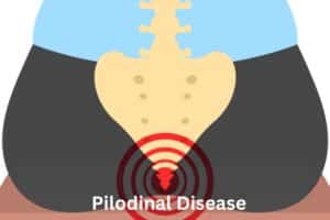 pilonidal disease